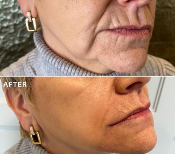 Sagging jowls before and after