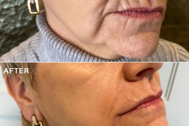 Sagging jowls before and after