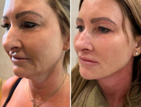 Jawline filler before and after