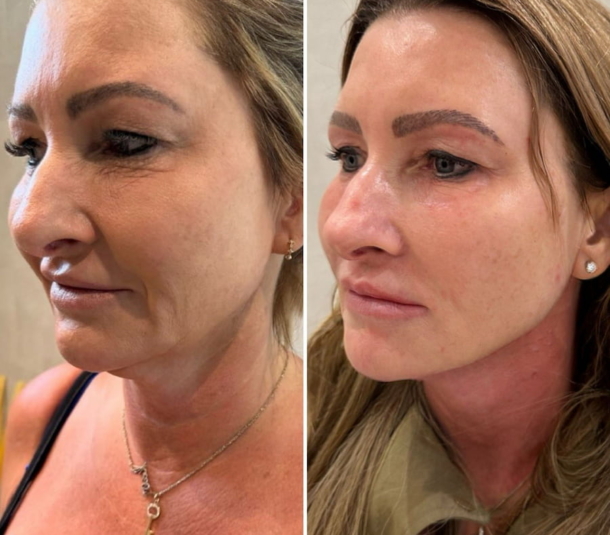 Jawline filler before and after