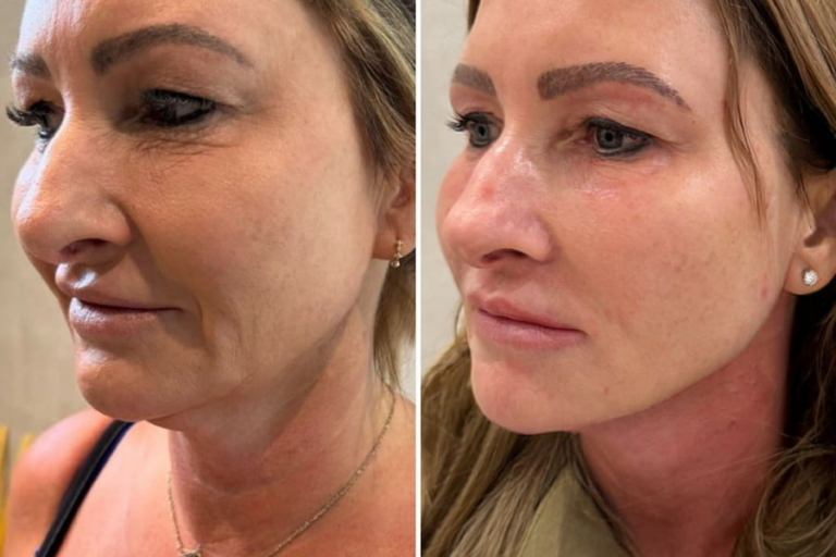 Jawline filler before and after