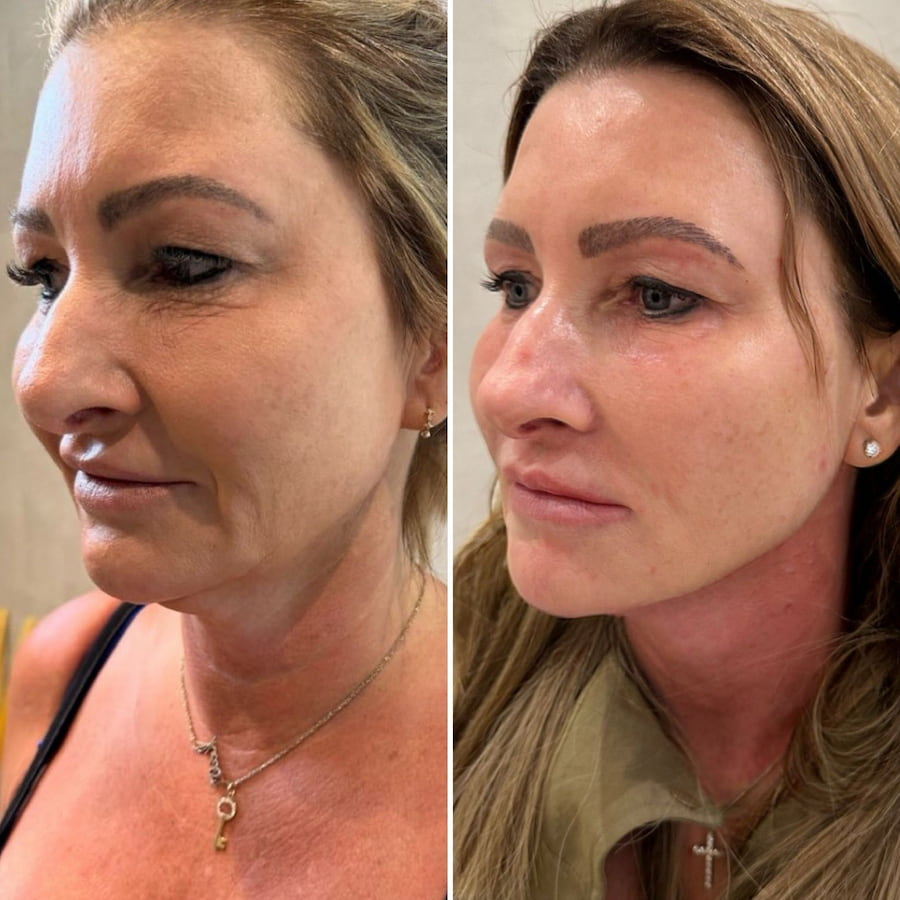 Sagging Jowls before and after