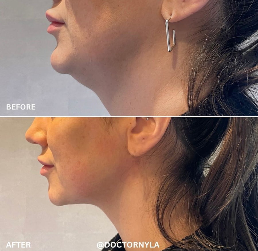 Sagging jowls before and after