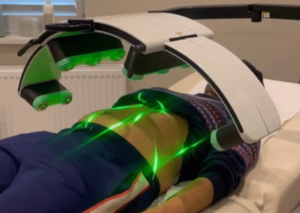 Emerald Laser Treatment