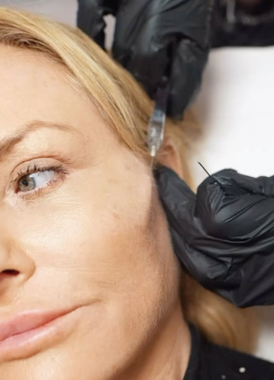 Feathering Dermal Filler Treament