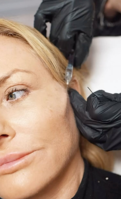 Feathering Dermal Filler Treament