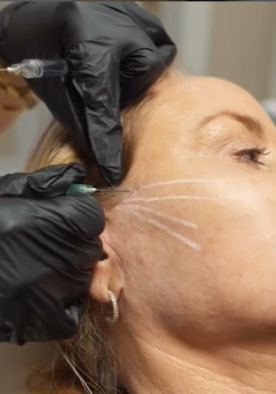 Feathering Filler Treament