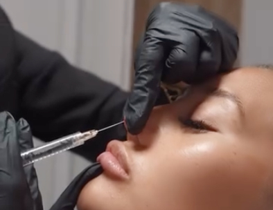 Non-Surgical Nose Reshaping