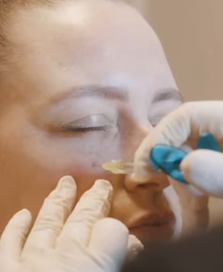 Tear Trough Filler Treatment