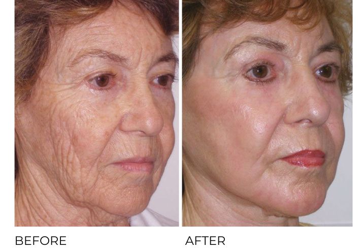 Ultrapulse Laser Skin Resurfacing Before & After 2