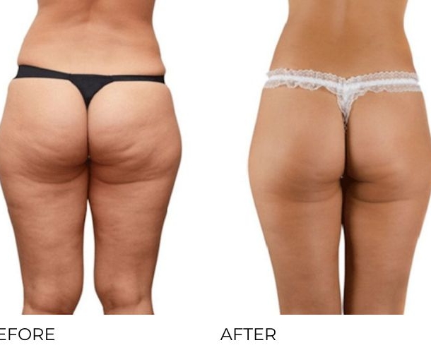 Unison Cellulite Treatment Before & After