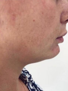 Aqualyx Fat Dissolving on Chin Before