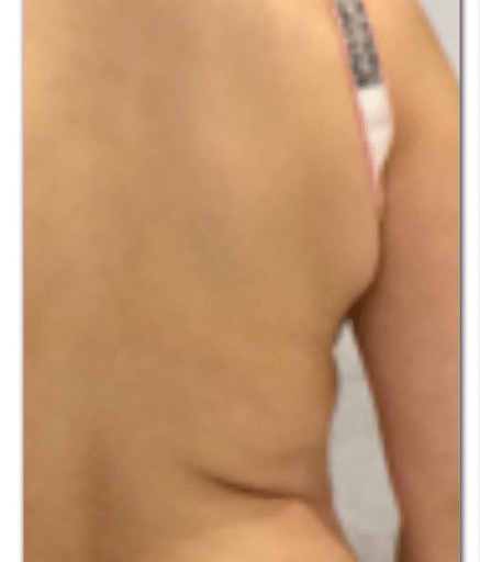 Aqualyx Fat Dissolving on Flanks Before