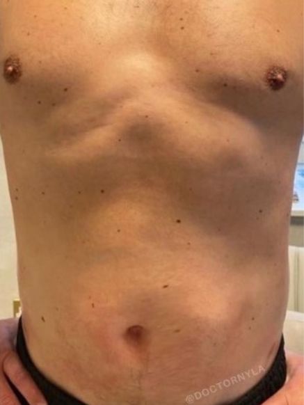 Men's Coolsculpting Treatment for Belly Fat After