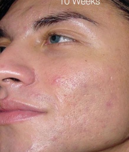 Men's Intracel ULTRACEL Before