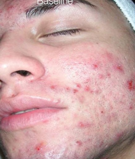 Men's Intracel ULTRACEL Before