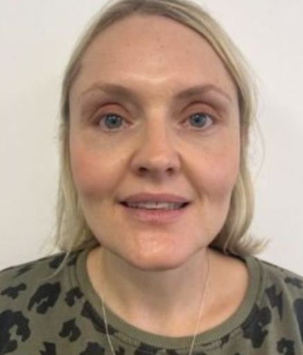 Polynucleotide Treatment for Under Eyes After