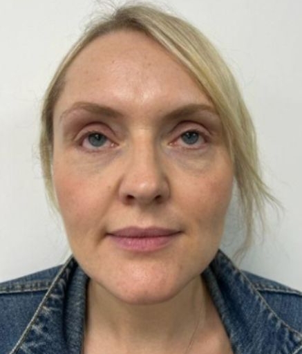 Polynucleotide Treatment for Under Eyes Before