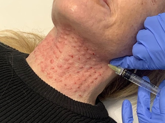 Polynucleotides Treatment on Neck