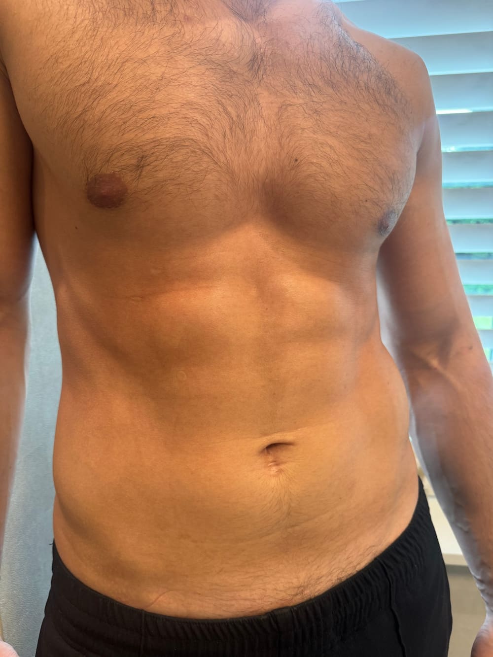 EMSculpt on Men's Abdomen