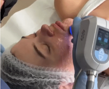 Exilis Elite Face