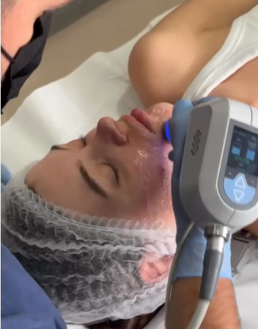 Exilis Elite Face