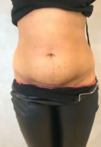 CoolSculpting for Belly Fat After