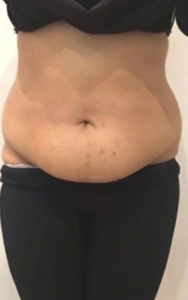 CoolSculpting for Belly Fat Before