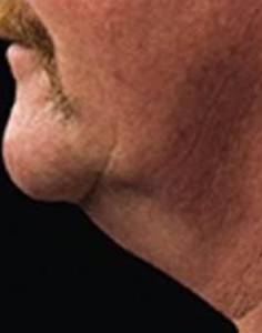 CoolSculpting for Men's Double Chin After