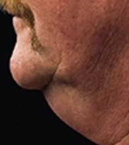 CoolSculpting for Men's Double Chin Before