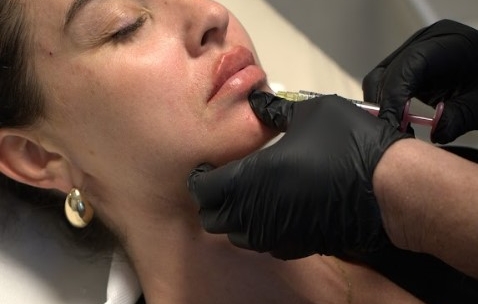 Dermal Filler