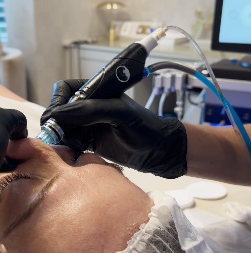 Hydrafacial In-Treatment