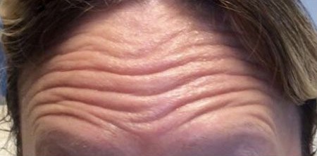 Skin Wrinkles on Forehead