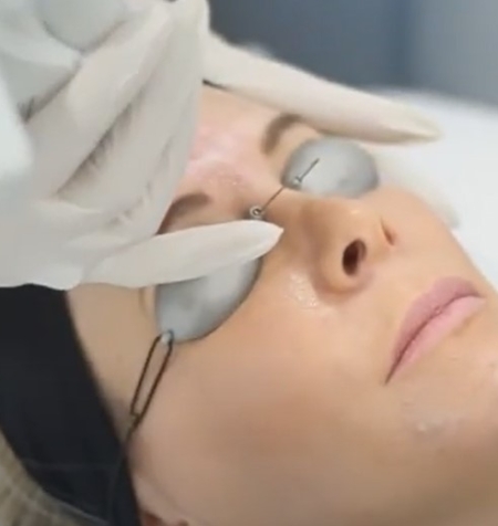 UltraPulse Laser Skin Resurfacing In-Treatment