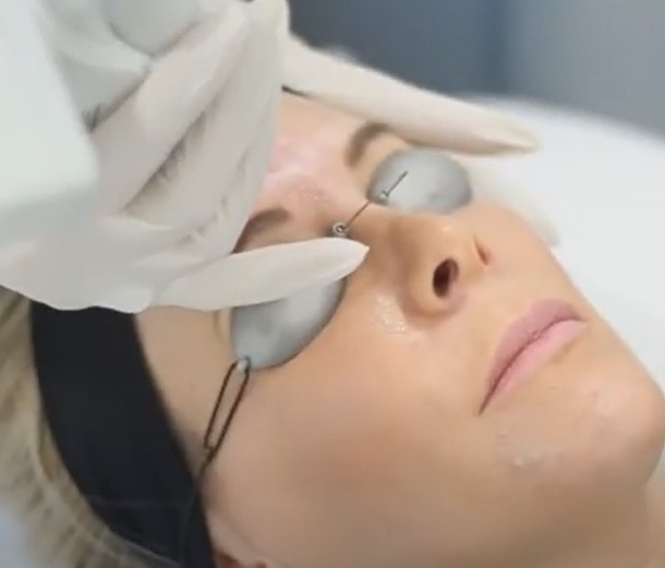 UltraPulse Laser Skin Resurfacing In-Treatment