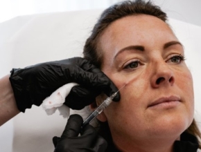 Under Eye Dermal Filler
