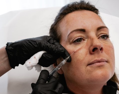 Under Eye Dermal Filler