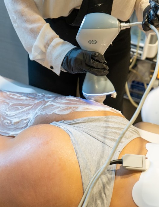 Unison Cellulite Treatment on Leg