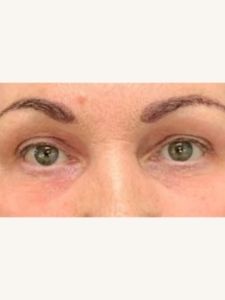 Best Eye Bags Treatment After