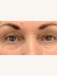 Best Eye Bags Treatment Before