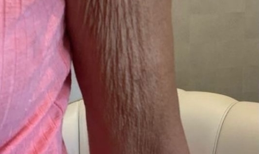 Crepey Arm Skin Treatment