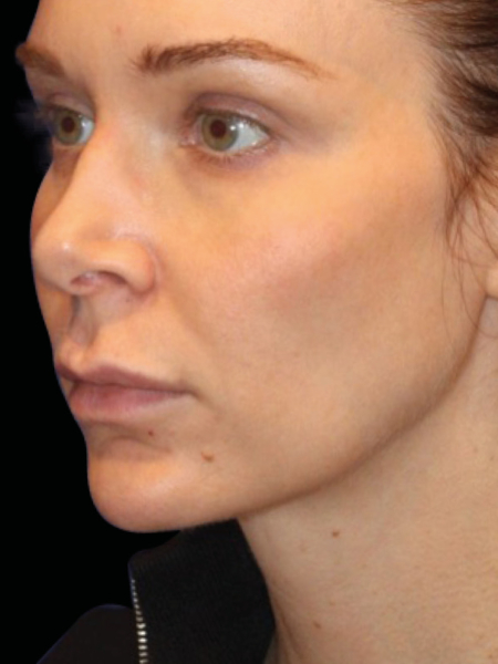 EmFace for Facial Sculpting After