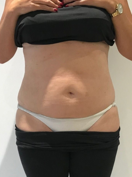 Emerald Laser Fat Reduction After