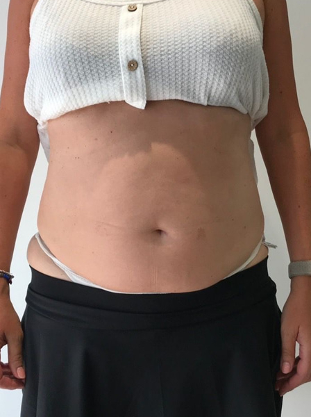 Emerald Laser Fat Reduction Before