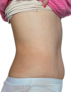 Emerald Laser for Stomach Toning After