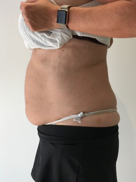 Emerald Laser on Belly Fat Before