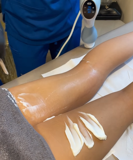 Exilis Elite Fat Reduction on Legs