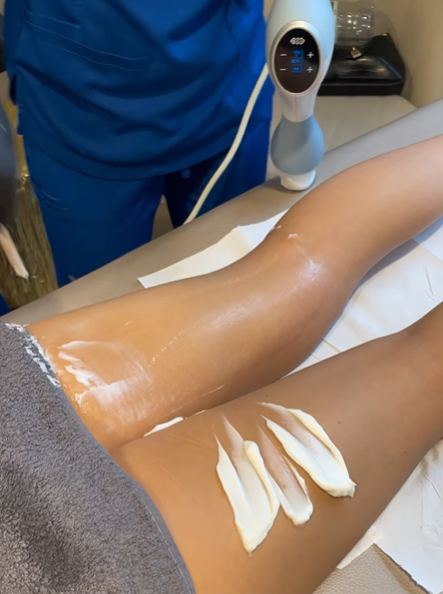 Exilis Elite Fat Reduction on Legs