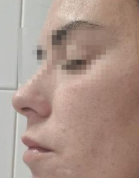 Exosomes Facial Skin Refresh After