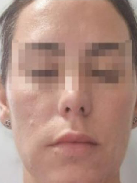 Exosomes Facial Skin Smoothing After